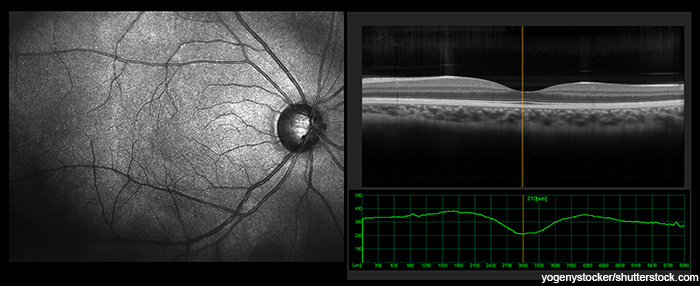 optical coherence tomography